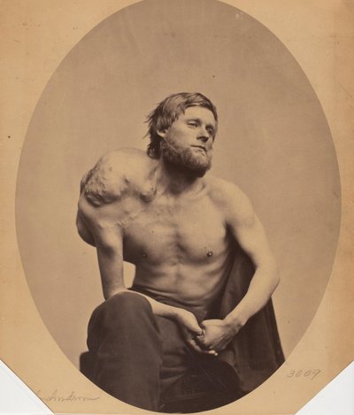 Enchondroma of the Scapula by James Wallace Black